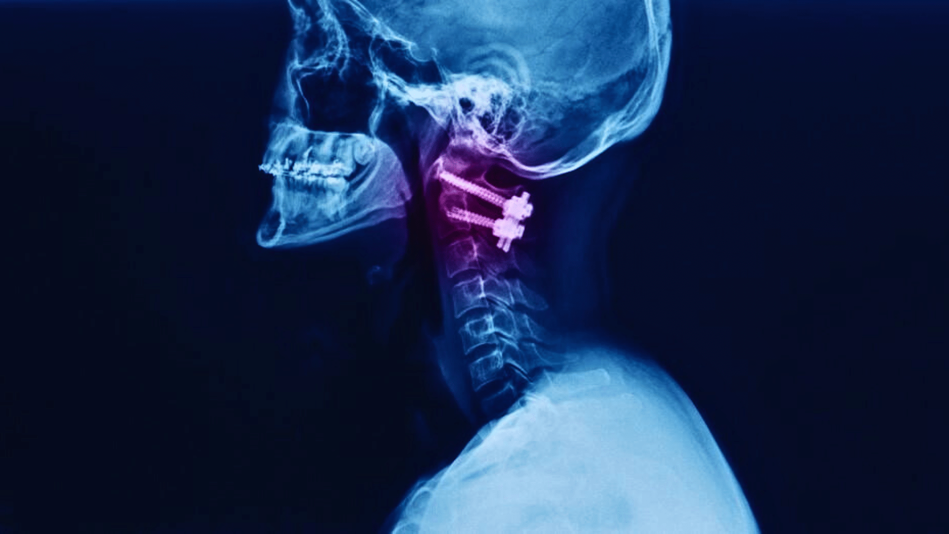 Anterior Cervical Discectomy
and Fusion