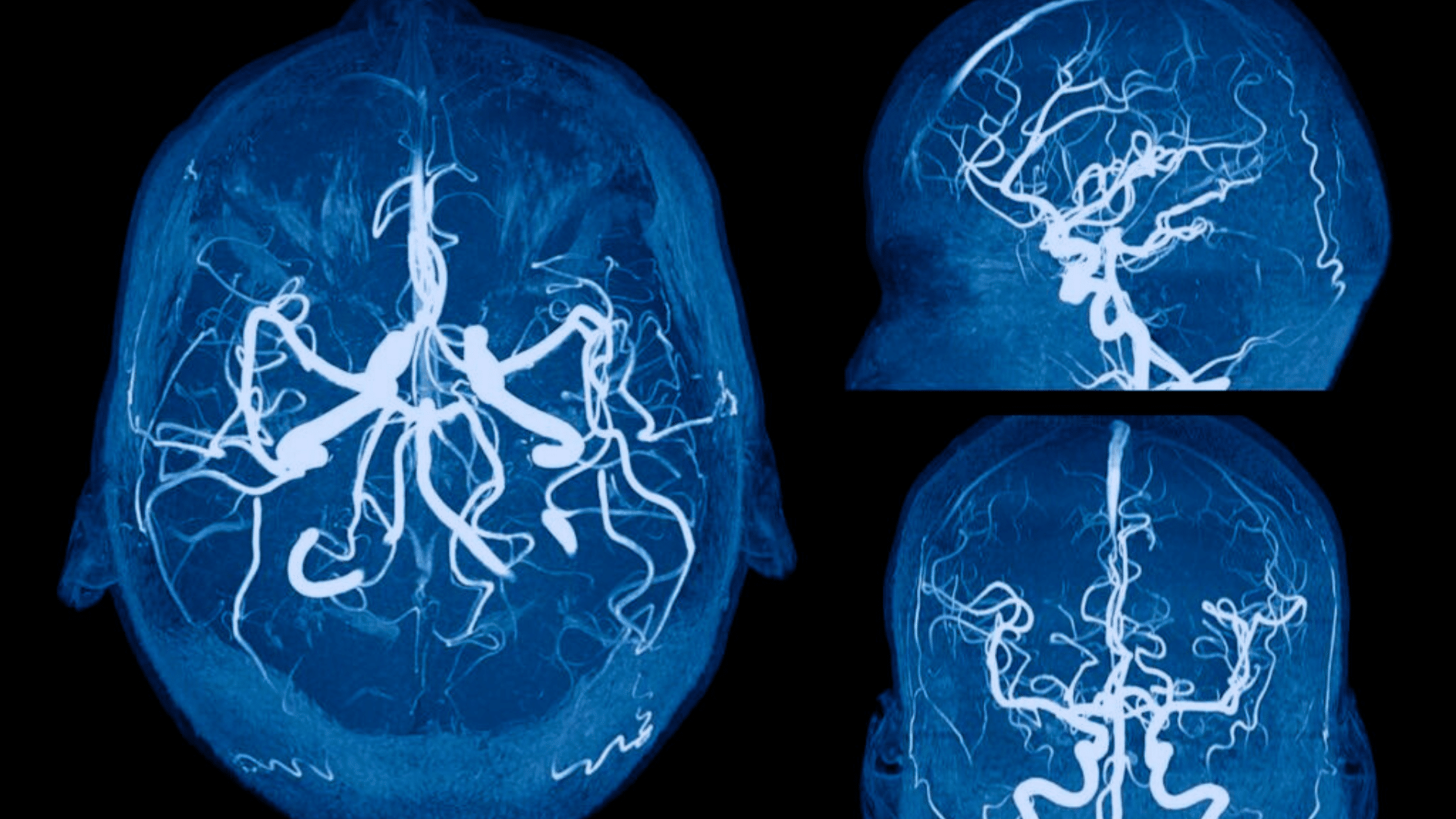 Cerebral
Angiogram